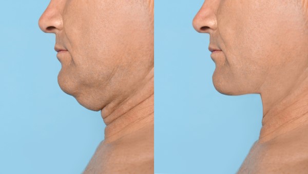 Which Non-Surgical Treatments Work Best for Jowls and Loose Skin Haverhill?