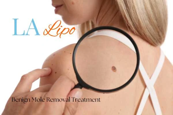 Woman having her inspection of blemish before mole removal Haverhill