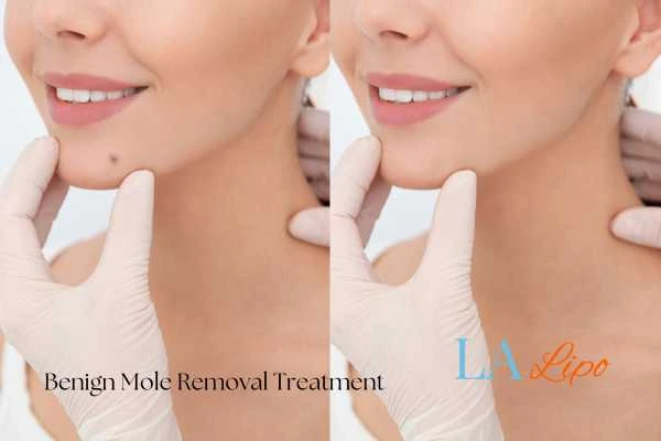 woman's before and after mole removal Haverhill results