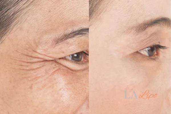 Before and after results of woman - HI-fu wrinkles reduction treatment Haverhill