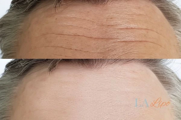 results of HIFU Haverhill on mans forehead to help reduce lines and wrinkles