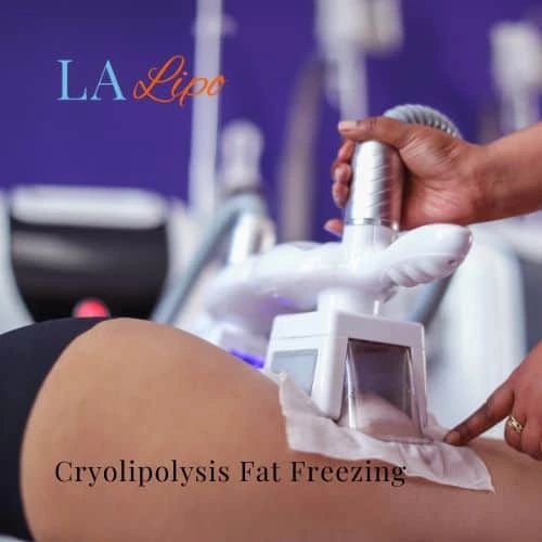 fat freezing - Cryolipolysis Haverhill