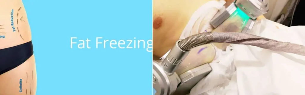 Fat freezing Haverhill on multiple areas of the body