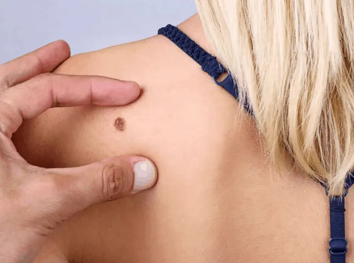 woman having mole removal Haverhill consultation before treatment.