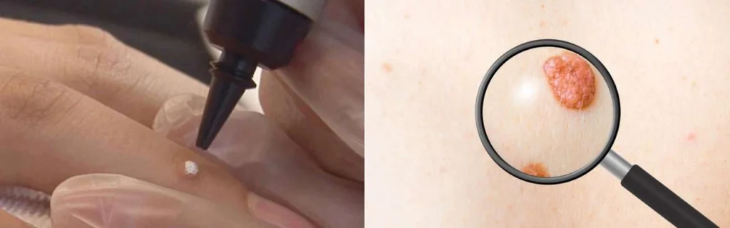 Person getting moles removed with cryopen Haverhill