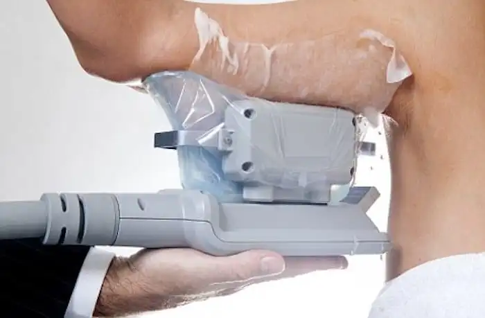 Picture of fat freezing Haverhill on the upper arms.