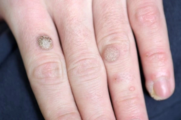 photo of warts on person hand - see wart removal Haverhill from LA LIPO