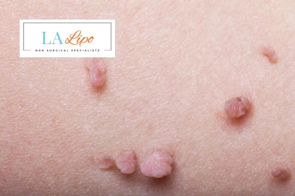 Does cryopen skin tag removal Haverhill hurt? Find out now call our team today!
