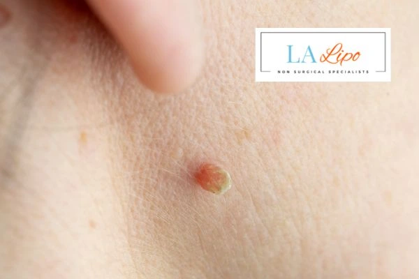 Book skin tag removal Haverhill today speak to our team now!