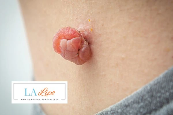 Interested in skin tag removal Haverhill? Concerned about the pain? Find out more today!
