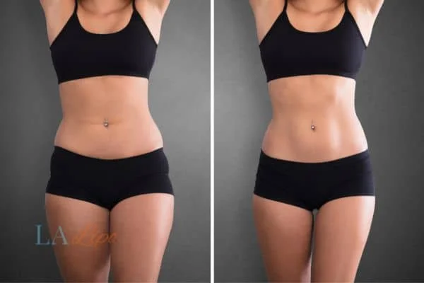 before and after results of non-surgical treatment to help a woman's body image and mental health Haverhill