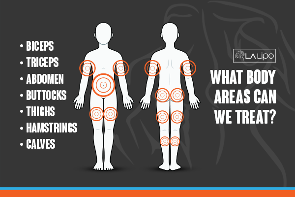 Diagram to show areas you can have LA-EMS Body Sculpting Treatment Haverhill