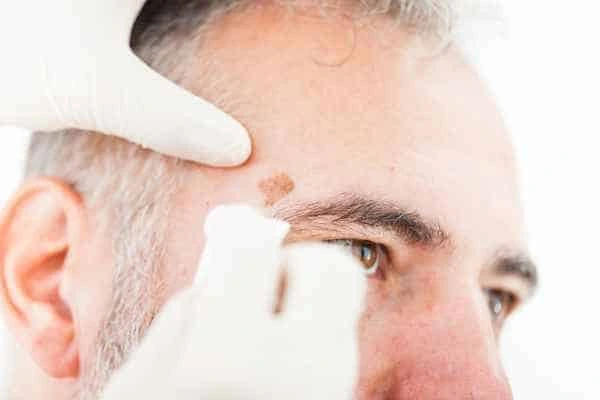 Age spots and elderly people Haverhill what is the link?