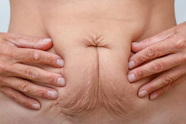Image of a woman's stomach with loose skin - example of skin tightening Haverhill options