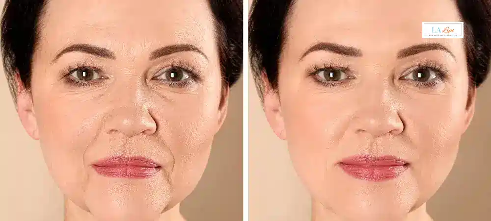 How Long Does It Take to See Results and How Long Do They Last Haverhill?