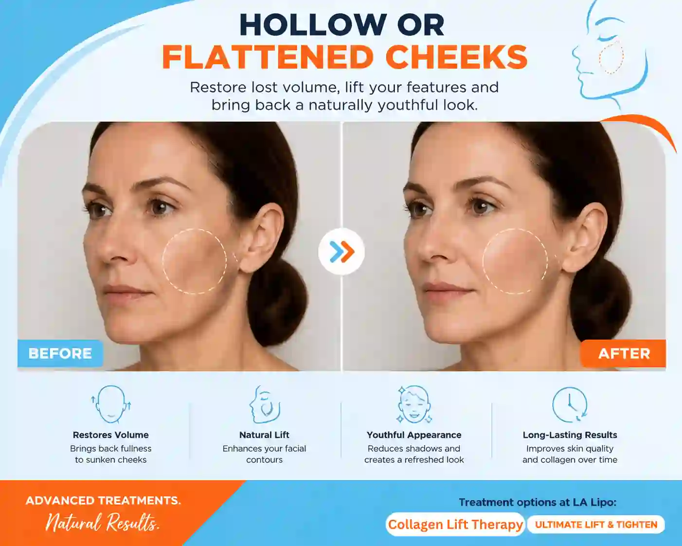 Sign #4: Hollow or Flattened Cheeks Haverhill